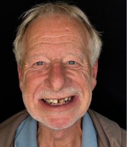 Smile Before Image