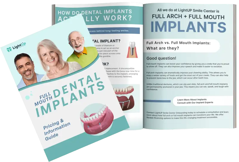Dental Implant Guide